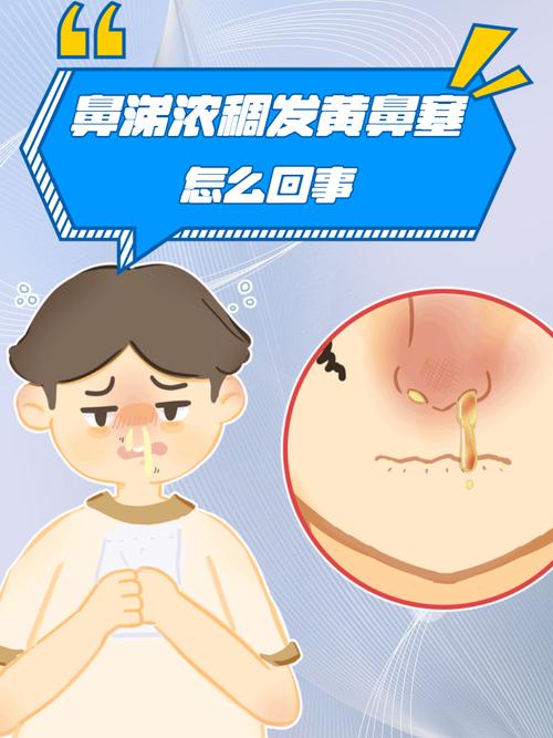 儿童鼻塞流黄鼻涕是感冒还是细菌感染?-第2张图片-中州医学会 儿童鼻塞流黄鼻涕是感冒还是细菌感染?-第2张图片-中州医学会