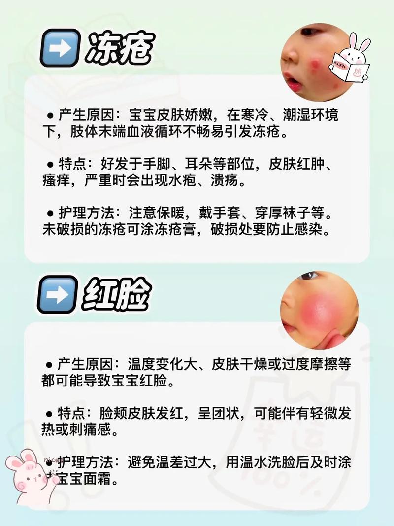 新生儿湿疹能用炉甘石吗？-第3张图片-中州医学会