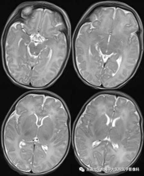 新生儿胆红素脑病早期临床表现-第1张图片-中州医学会