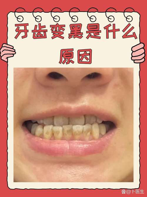 孕期牙齿为何会变黑?-第2张图片-中州医学会 孕期牙齿为何会变黑?-第2张图片-中州医学会