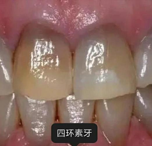 孕期牙齿为何会变黑?-第3张图片-中州医学会 孕期牙齿为何会变黑?-第3张图片-中州医学会