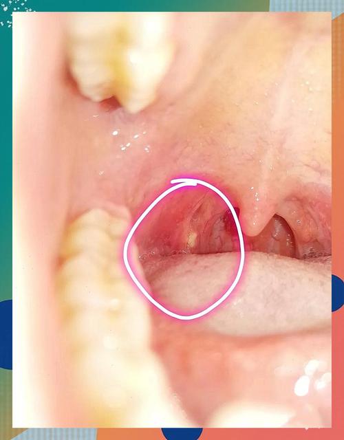 儿童扁桃体白色脓点怎么快速消除？-第2张图片-中州医学会