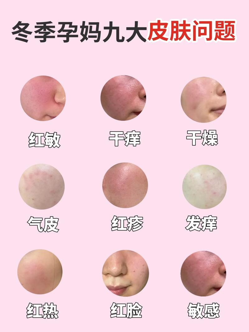 孕期为何脸上长粉刺？-第2张图片-中州医学会