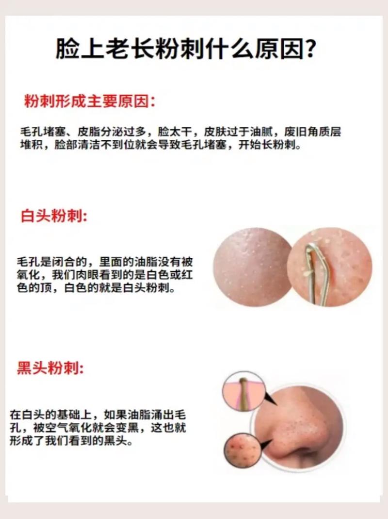 孕期为何脸上长粉刺？-第3张图片-中州医学会