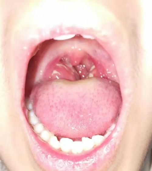 儿童扁桃体肥大，中医能治吗？-第1张图片-中州医学会