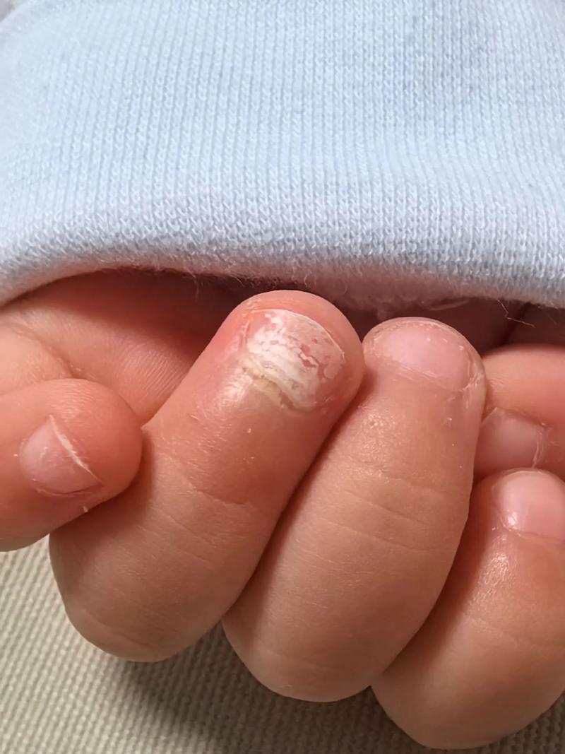 儿童指甲白斑是缺钙还是生病了？-第1张图片-中州医学会