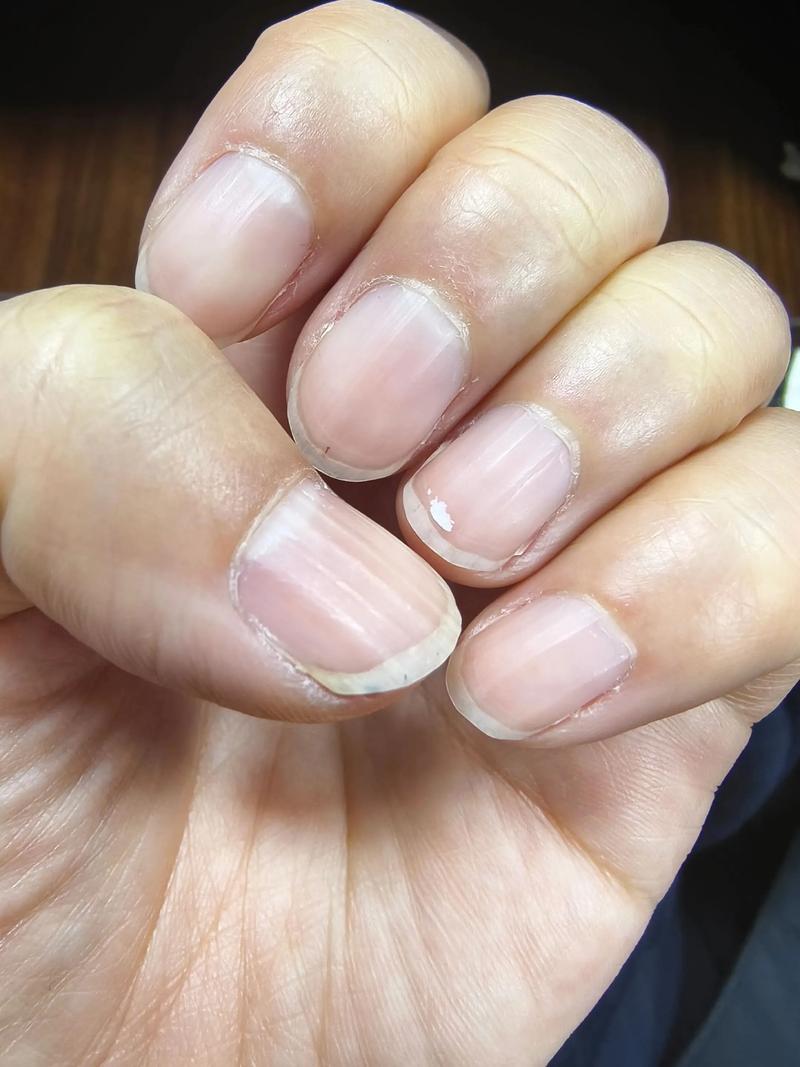 儿童指甲白斑是缺钙还是生病了？-第3张图片-中州医学会