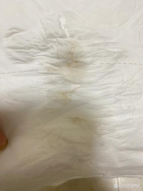 孕期白带发黄无异味无瘙痒要紧吗？-第2张图片-中州医学会