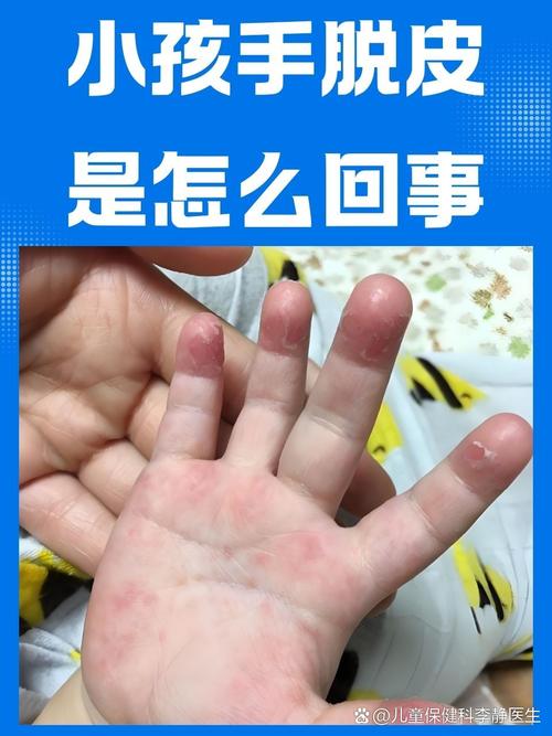 10岁孩子手脱皮，是缺乏营养还是生病了？-第2张图片-中州医学会
