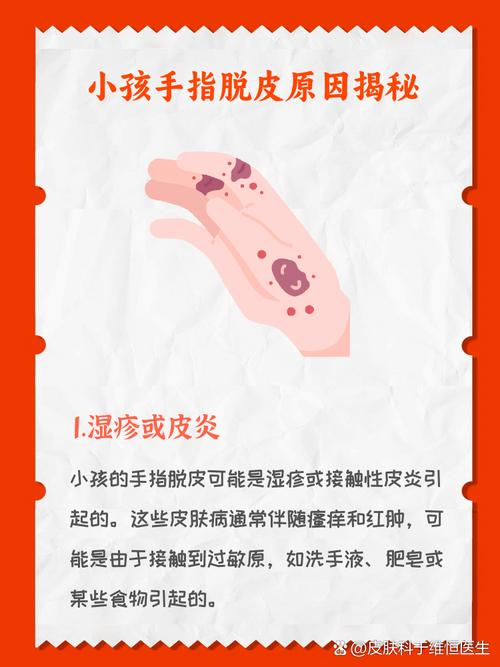 10岁孩子手脱皮，是缺乏营养还是生病了？-第3张图片-中州医学会