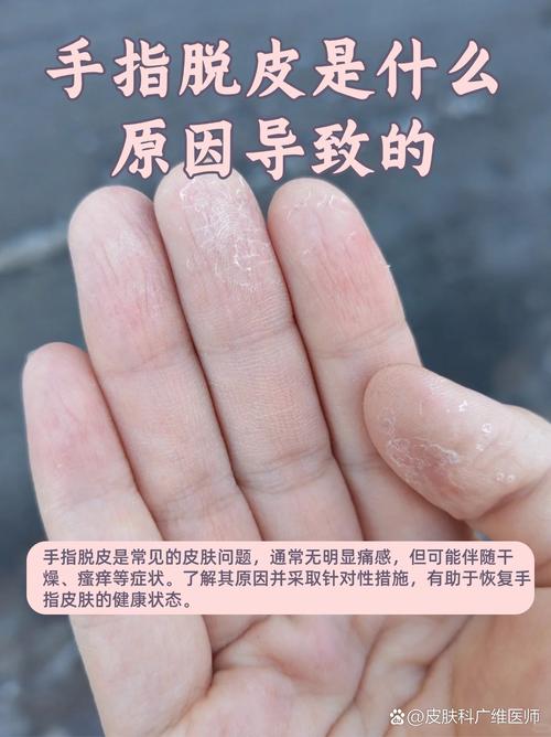 10岁孩子手脱皮,是缺乏营养还是生病了?-第1张图片-中州医学会 10岁孩子手脱皮,是缺乏营养还是生病了?-第1张图片-中州医学会