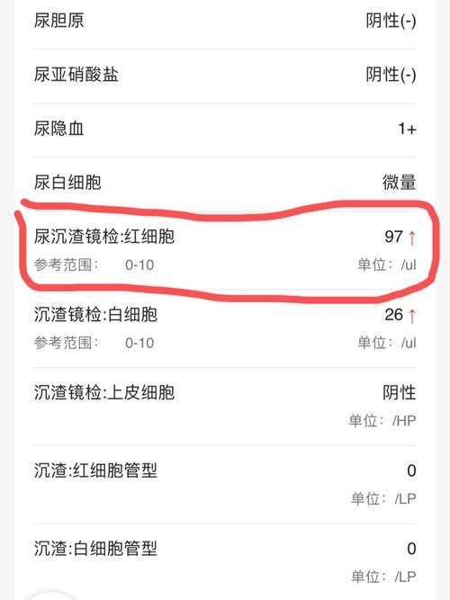 儿童尿检红细胞高，究竟是什么原因？-第3张图片-中州医学会