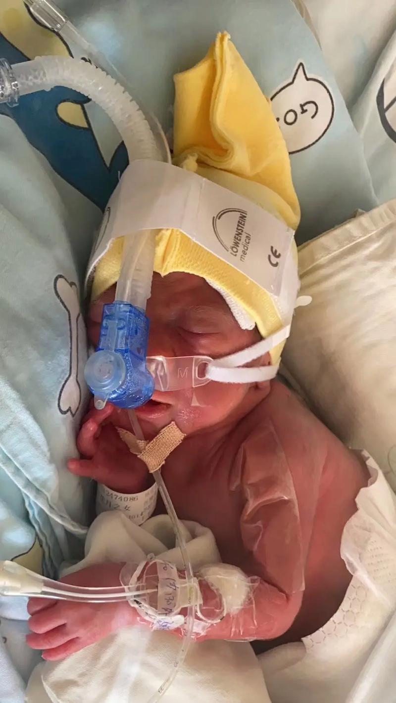 SLE50000新生儿呼吸机有何核心技术优势？-第2张图片-中州医学会