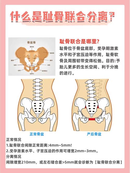 孕期耻骨分离产后多久能恢复？-第2张图片-中州医学会