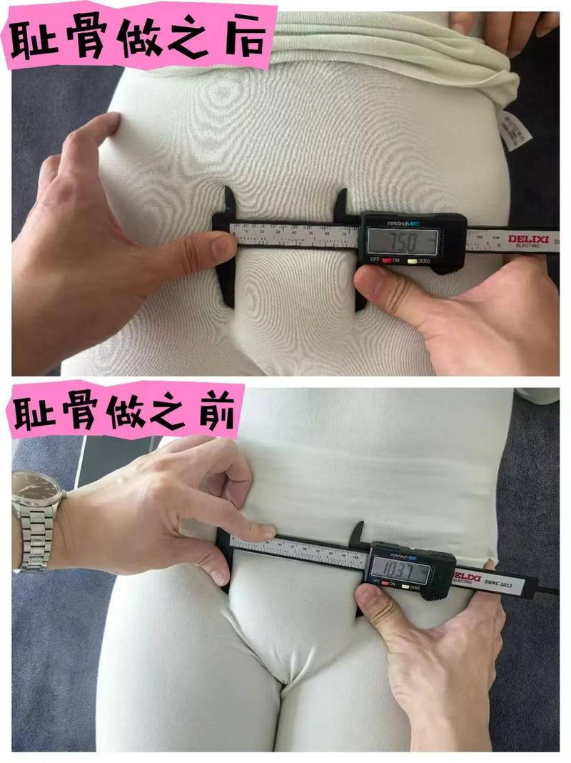 孕期耻骨分离产后多久能恢复?-第1张图片-中州医学会 孕期耻骨分离产后多久能恢复?-第1张图片-中州医学会