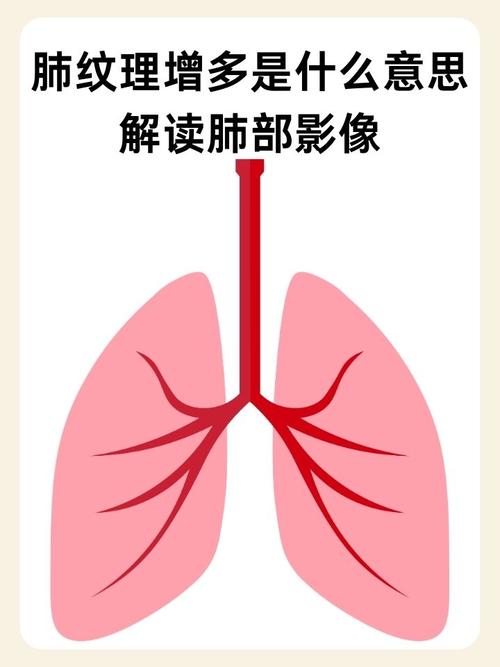 新生儿两肺纹理增多是病吗？-第2张图片-中州医学会