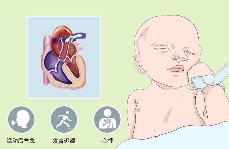 新生儿动脉导管未闭症状有哪些？-第3张图片-中州医学会