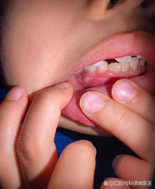 儿童牙龈凸起肉疙瘩是何问题？-第1张图片-中州医学会