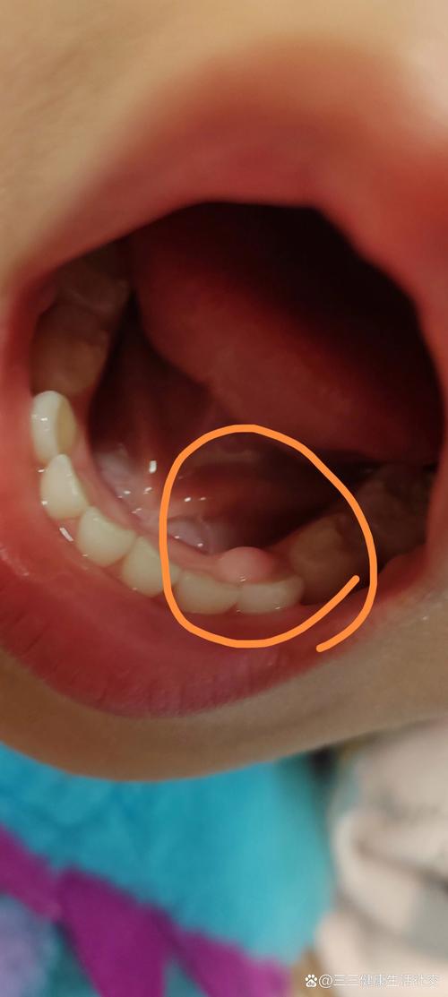 儿童牙龈凸起肉疙瘩是何问题？-第2张图片-中州医学会