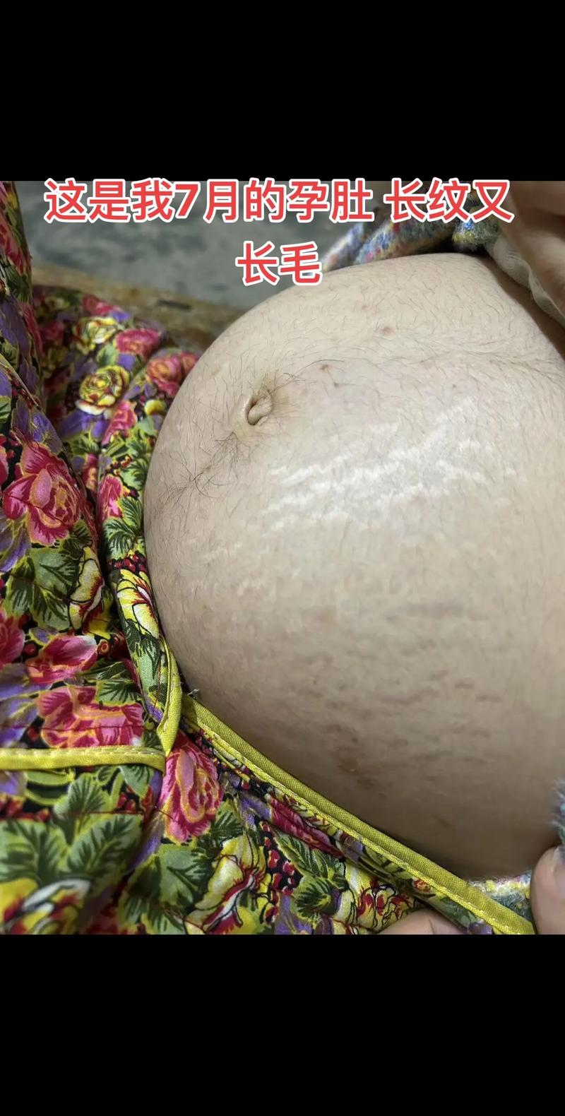 孕期肚毛增长是激素变化吗？-第2张图片-中州医学会