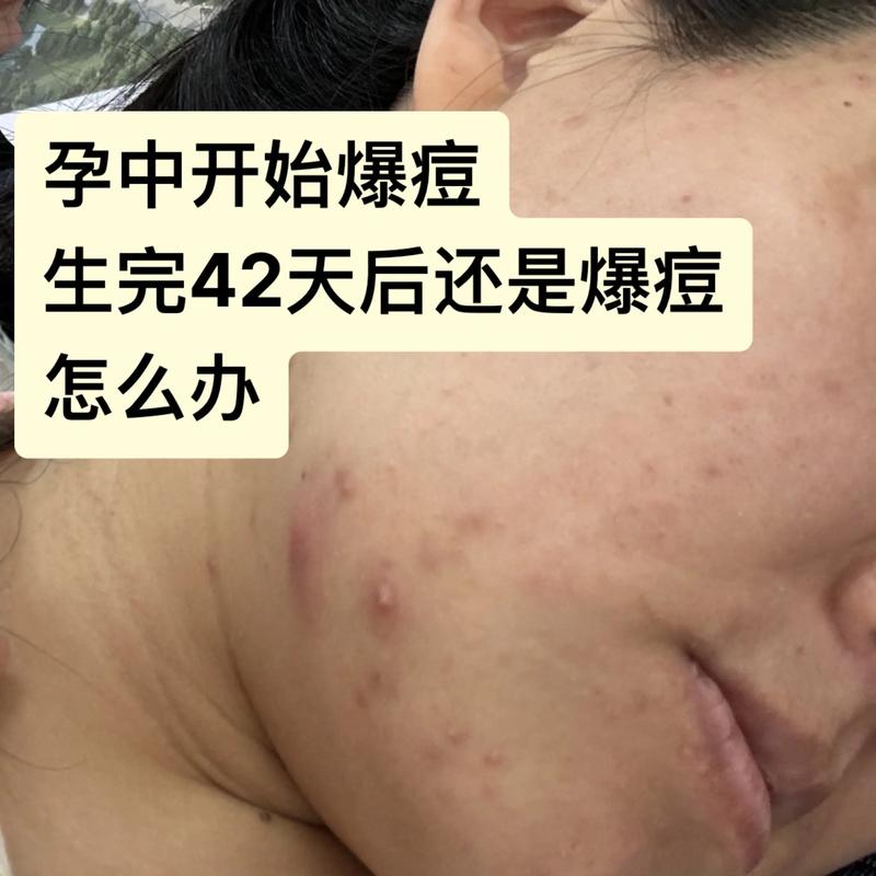 孕期痘痘频发，激素变化还是其他原因？-第1张图片-中州医学会
