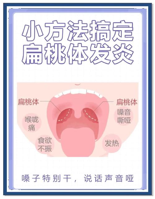 儿童扁桃体发炎,最佳治疗方法是什么?-第1张图片-中州医学会 儿童扁桃体发炎,最佳治疗方法是什么?-第1张图片-中州医学会