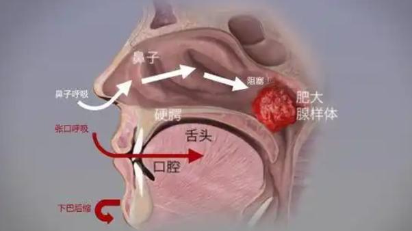 儿童腺样体肥大,睡眠监测指标有何关键意义?-第3张图片-中州医学会 儿童腺样体肥大,睡眠监测指标有何关键意义?-第3张图片-中州医学会