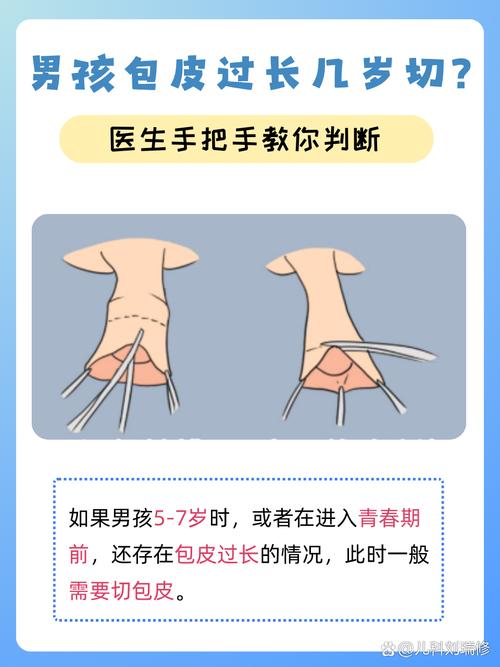 8岁儿童如何判断是否包茎？-第2张图片-中州医学会