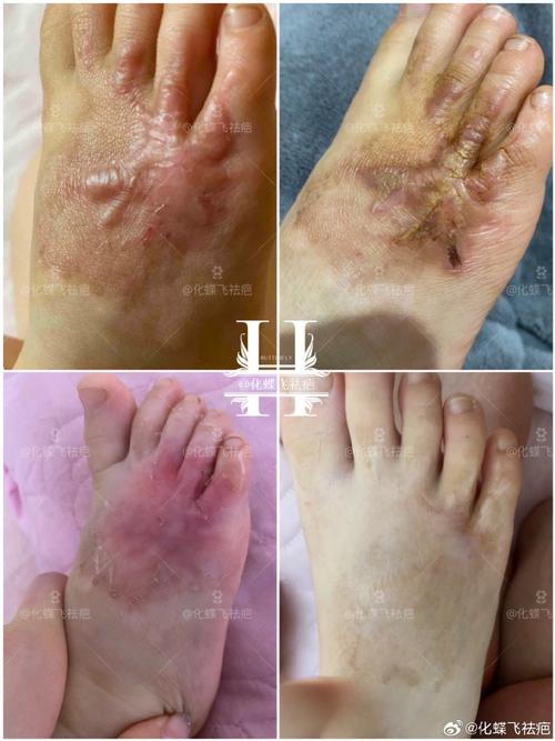 儿童烫伤疤痕修复，哪家医院最好？-第1张图片-中州医学会