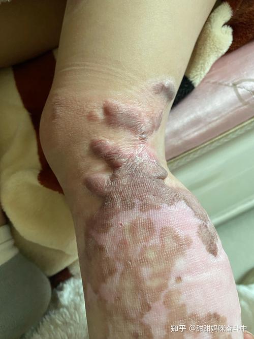 儿童烫伤疤痕修复，哪家医院最好？-第3张图片-中州医学会