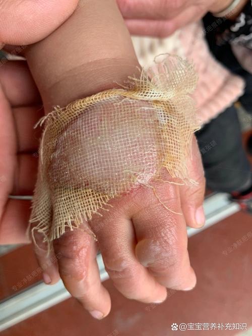 儿童烫伤疤痕修复，哪家医院最好？-第2张图片-中州医学会