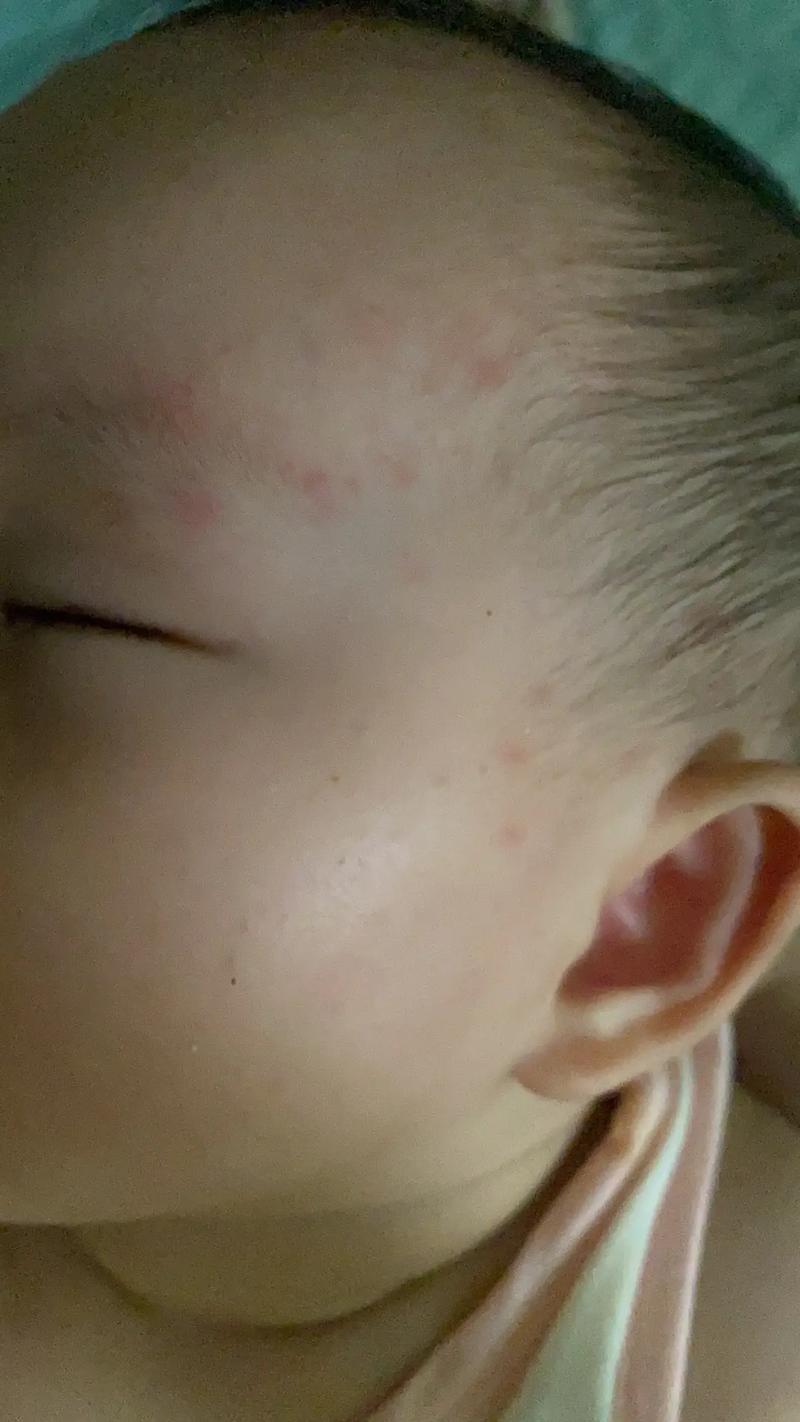 新生儿打乙肝疫苗后会有哪些反应？-第3张图片-中州医学会