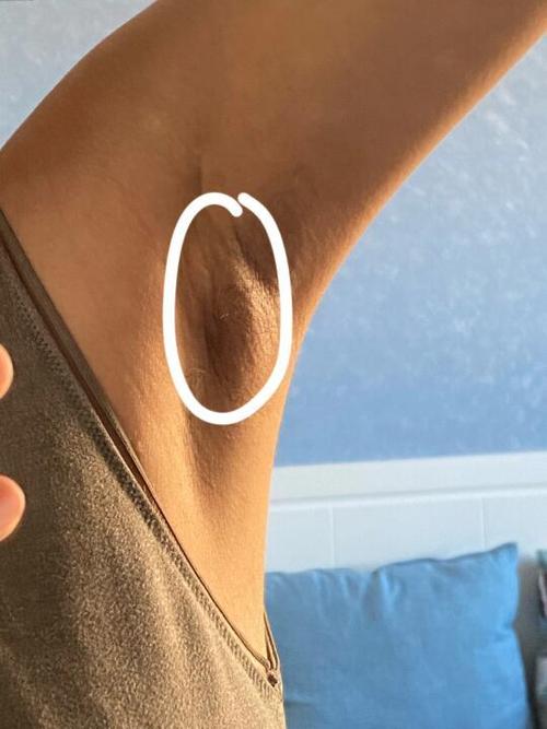 孕期腋下疼肉疙瘩是何原因？-第2张图片-中州医学会