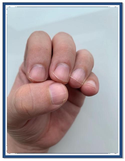 儿童指甲竖纹是缺营养还是生病了？-第3张图片-中州医学会