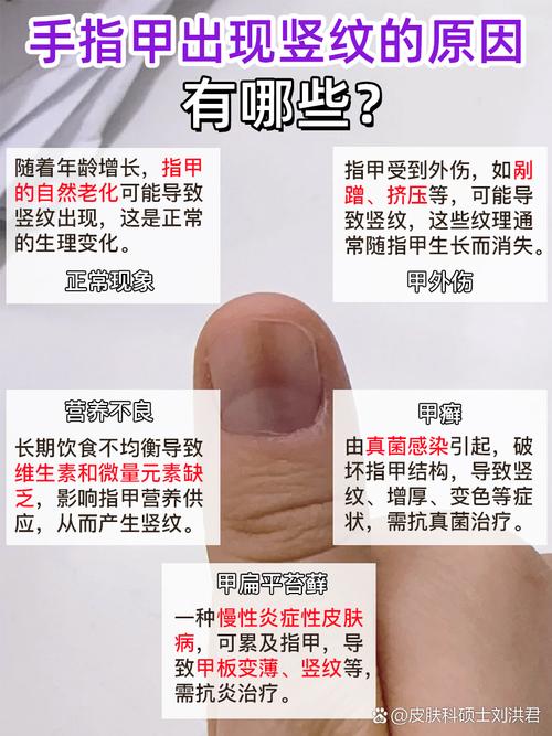 儿童指甲竖纹是缺营养还是生病了？-第1张图片-中州医学会