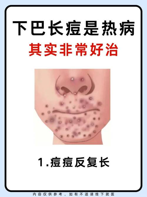 孕期下巴长痘是激素变化还是其他原因?-第1张图片-中州医学会 孕期下巴长痘是激素变化还是其他原因?-第1张图片-中州医学会