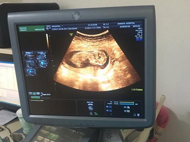 孕期13周NT检查是啥？-第3张图片-中州医学会