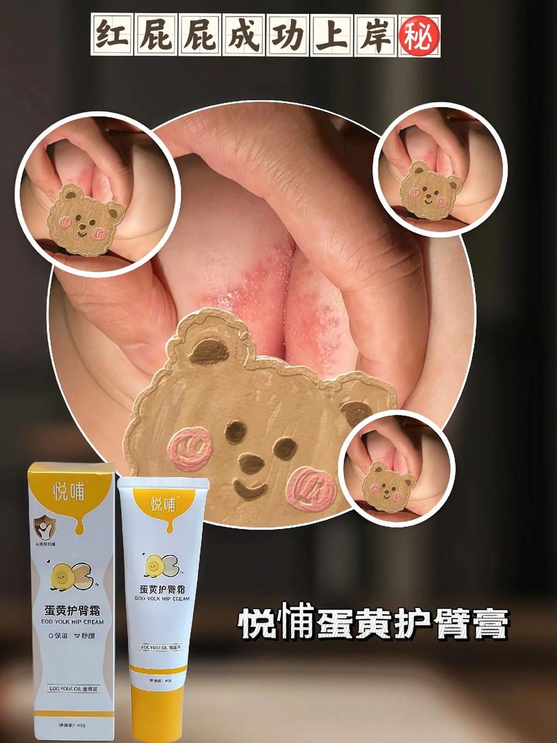 新生儿红屁股能用爽身粉吗？-第2张图片-中州医学会