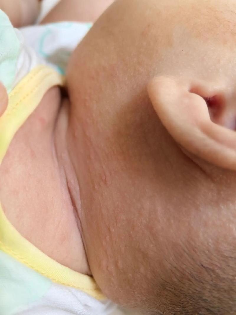 新生儿长湿疹能打预防针吗？-第1张图片-中州医学会