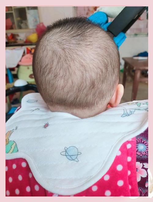 儿童脱发是缺营养还是疾病信号？-第2张图片-中州医学会