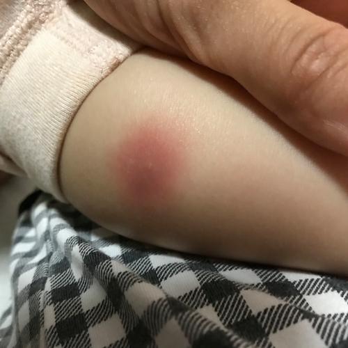 孩子腿上红疙瘩痒怎么办?-第1张图片-中州医学会 孩子腿上红疙瘩痒怎么办?-第1张图片-中州医学会