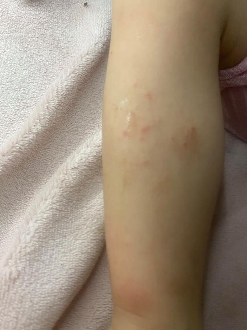 孩子腿上红疙瘩痒怎么办?-第2张图片-中州医学会 孩子腿上红疙瘩痒怎么办?-第2张图片-中州医学会