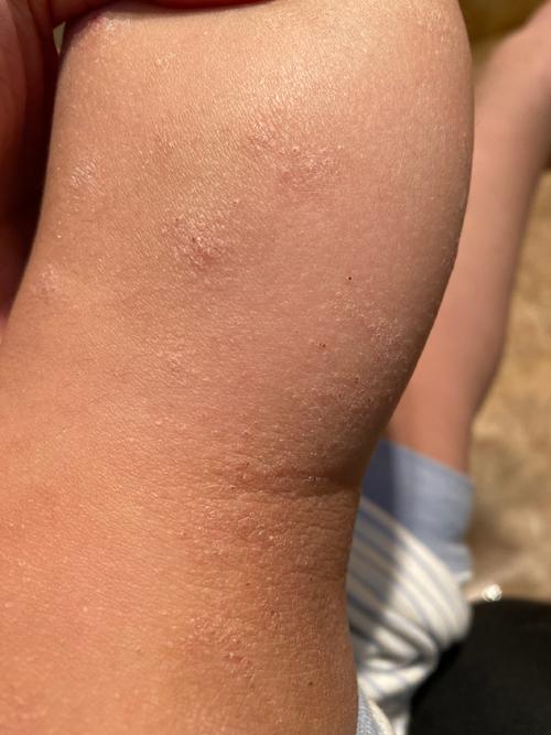 孩子腿上红疙瘩痒怎么办？-第3张图片-中州医学会