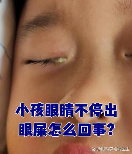 新生儿右眼黄脓眼屎是何原因？-第3张图片-中州医学会