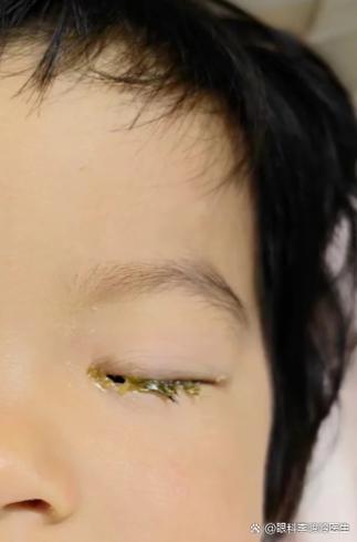 新生儿右眼黄脓眼屎是何原因？-第1张图片-中州医学会