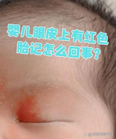 新生儿上眼皮发红是何原因？-第1张图片-中州医学会