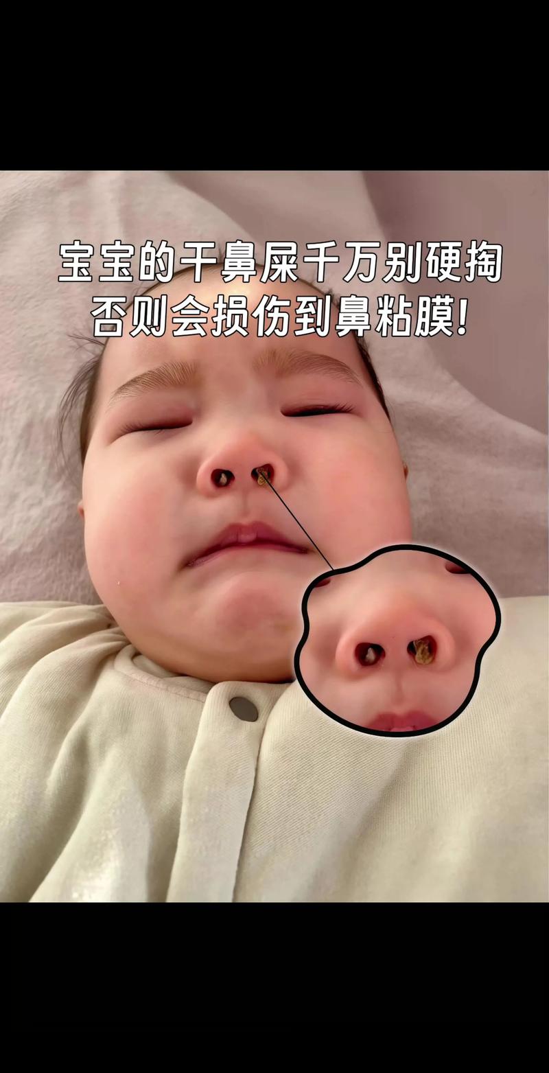 新生儿鼻孔鼻屎怎么安全取出？-第3张图片-中州医学会