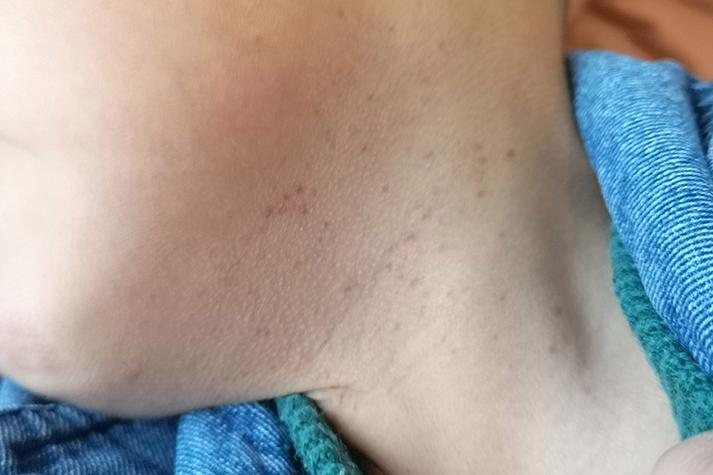 儿童特发性血小板减少性紫癜为何高发?-第2张图片-中州医学会 儿童特发性血小板减少性紫癜为何高发?-第2张图片-中州医学会