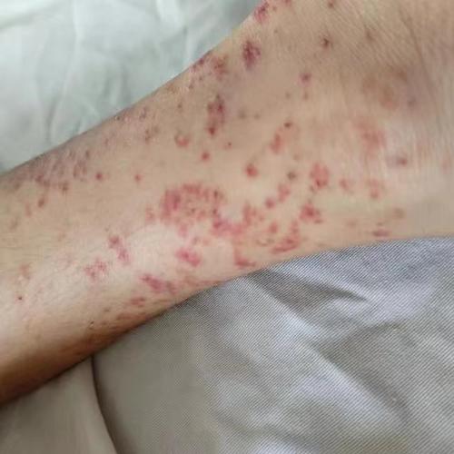 儿童特发性血小板减少性紫癜为何高发?-第1张图片-中州医学会 儿童特发性血小板减少性紫癜为何高发?-第1张图片-中州医学会