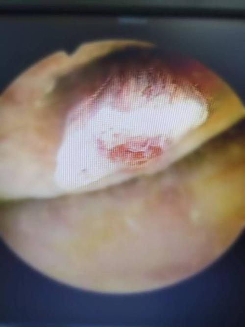 孕期阴道出血是危险信号吗？-第3张图片-中州医学会